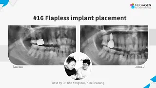 Dr. Yongseok CHO, Sewoung KIM, #16 flapless implant surgery and prosthesis