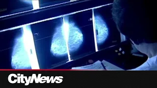 Canadians disappointed by updated breast cancer screening guidelines