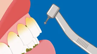 how much do you know about dental scaling?