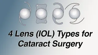 4 Main Lens (IOL) Types for Cataract Surgery: Pros and Cons (Basic Version)