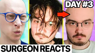 How I Lost ALL My Hair in 3 Days | Surgeon Reacts