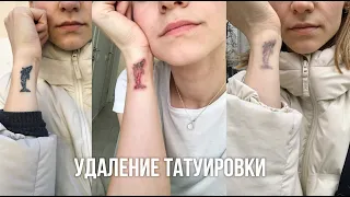 УДАЛЕНИЕ ТАТУИРОВКИ | Karolina K