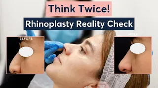 Rhinoplasty Controversial Facts No One Talks About