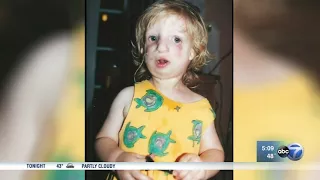 ABC7 Chicago - Teen talks about having Treacher Collins Syndrome, as seen in movie Wonder