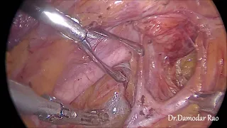 Lateral Avascular spaces in the Pelvis