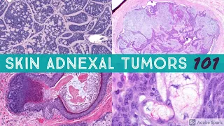 Skin Adnexal Tumors 101: A Basic Approach for General Pathologists