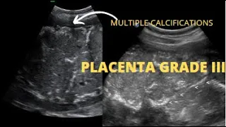 Grade iii Placental Calcifications | 38 weeks of Gestation