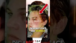 Leonardo DiCaprio Got 17 Stitches on His Face 🤯