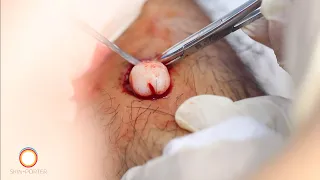 Clean Ganglion cyst removal surgery 2020 HD 腱鞘囊肿切除微手術 高清