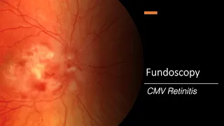 CMV Retinitis: Fundoscopy