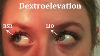 ORT5CLA Ocular Movements