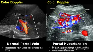 Portal Vein Color & Spectral Doppler Ultrasound Normal Vs Abnormal Images | Liver Vascular USG Scan