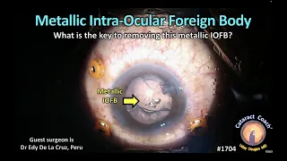 CataractCoach™1704: metallic intra-ocular foreign body