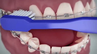 Brushing and Flossing With Braces - Spanish