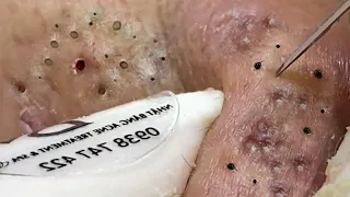 Removal Hidden Blackheads At Loan Nguyen Spa | 26