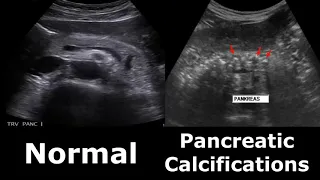 Pancreas Ultrasound Normal Vs Abnormal Appearances Comparison   Pancreas Pathologies On Ultrasound