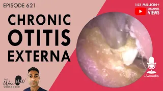 621 - Chronic Otitis Externa