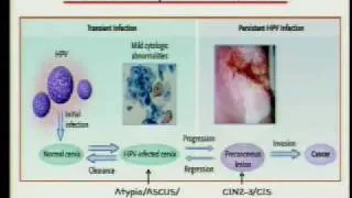 HPV and Cervical Cancer: 25 Years from Discovery to Vaccine