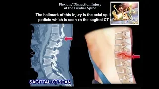 Flexion Distraction Injury Of The lumbar  Spine - Everything You Need To Know - Dr. Nabil Ebraheim