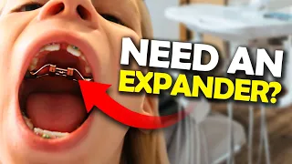 Getting a Palatal Expander? What you NEED to know | McKinney Orthodontist
