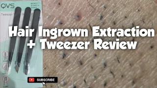 Ingrown Hair Extraction using my new tweezers