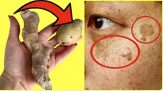 Shocking 😮She Wiped the Dark Spots Off Her Face with Potatoes and Ginger in Just 20 Minutes