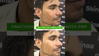 Fractional Co2 Laser With Prp | Viral #shorts