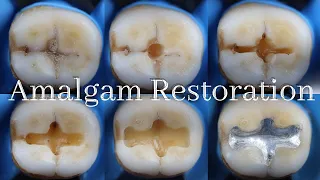 Amalgam Restoration ⚪️ Class I Amalgam Cavity Preparation & Restoration