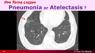 Pneumonia or Atelectasis?