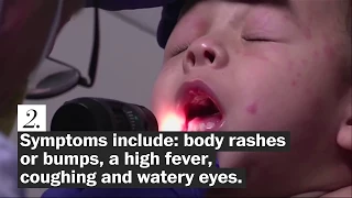 Five things to know about measles