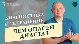 Что такое диастаз и нужно ли с ним бороться? // 18+