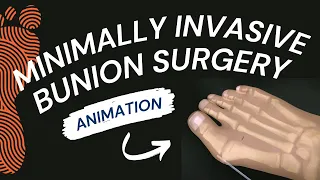 Minimally Invasive Bunion Surgery: A Short Animation