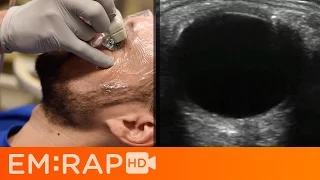 Ultrasound of Retinal vs Vitreous Detachment