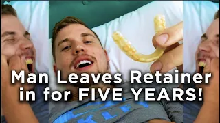 Man Leaves Retainer in for FIVE YEARS! 💀🧐 #Shorts