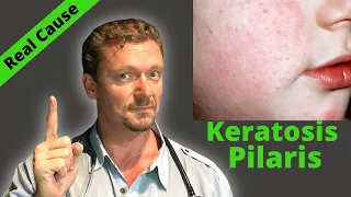 KERATOSIS PILARIS Fix? (Sign of Serious Condition?) Chicken Skin Cure