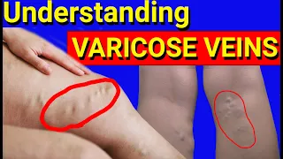 Varicose veins: signs, causes and treatment