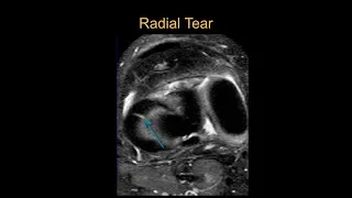 TMT: MRI Knee Meniscal Tears by Dr Srijita Ghosh