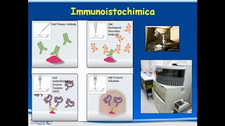 La diagnosi Patologica dei sarcomi dell' osso e delle parti molli