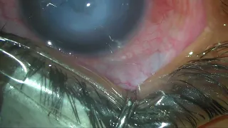 ACUTE HYDROPS PRE DUA CORNEAL SUTURING