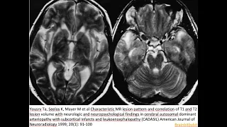 70. CADASIL; Notch3, arteriopathy, pericyt, blood brain barrier, anterior temporal pole, stroke