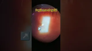 Skin papilloma of eyelid | Папілома шкіри повіки | Папиллома кожи века