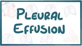 Pleural Effusion - causes, symptoms, diagnosis, treatment, pathology