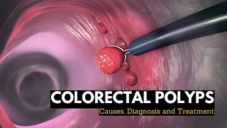 Colorectal Polyps, Causes, Signs and Symptoms, Diagnosis and Treatment.