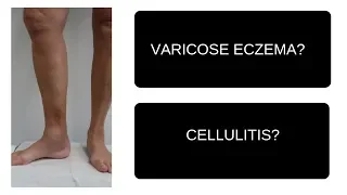 Varicose Eczema | Cellulitis | Which is it?