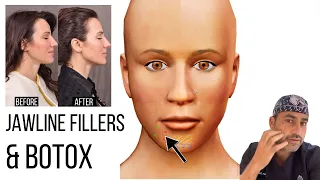 Jawline Fillers & Botox Tips | What to Know! | Beverly Hills Facial Plastic Surgeon Dr. Ben Talei