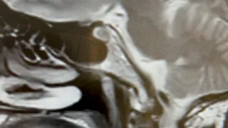 How to identify Thornwaldt Cyst on MRI