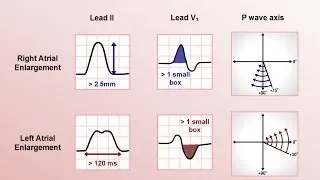 Intro to EKG Interpretation - Chamber Enlargement