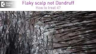 Get rid of itchy white flaky scalp which is not dandruff - Dr. Rashmi Ravindra| Doctors' Circle