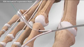 EDB InternalBrace™ Augmentation Repair