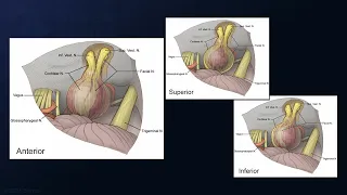 Retrosigmoid Craniotomy for Resection of a Vestibular Schwannoma